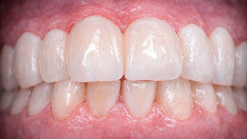 bulky veneers